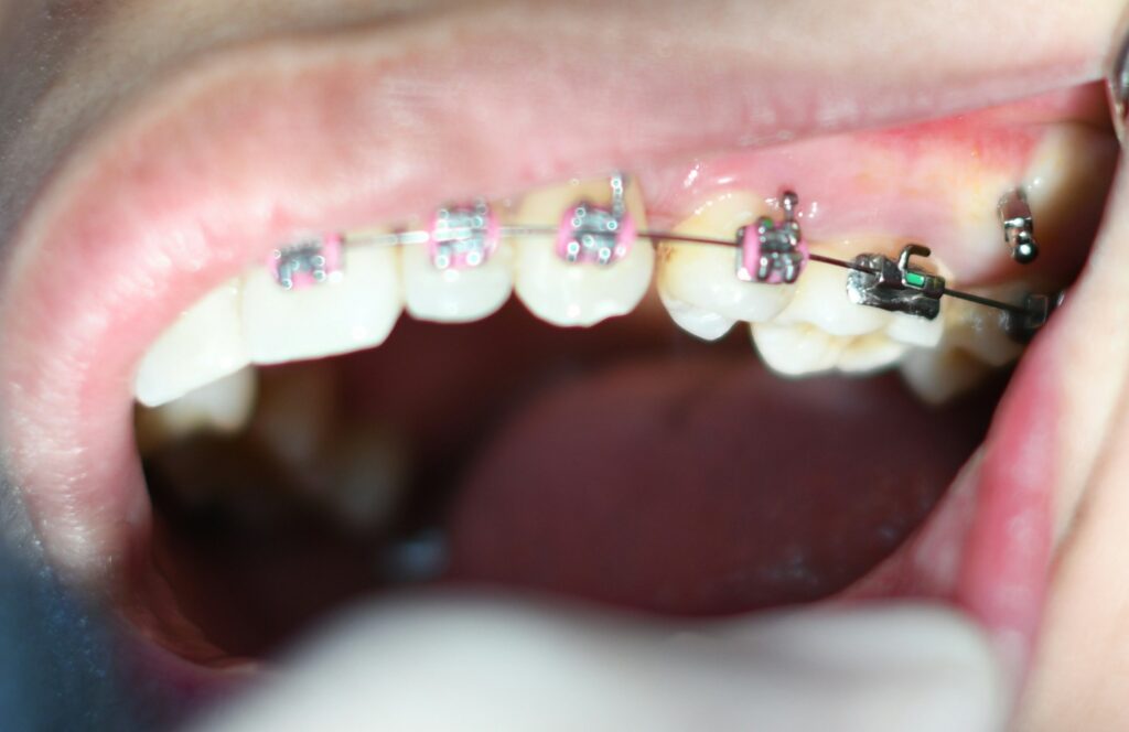 orthodontic braces